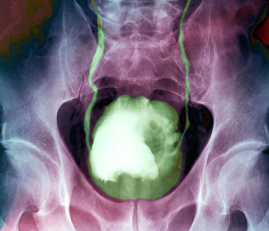 Bladder Cancer #4 Photograph by Zephyr/science Photo Library - Pixels