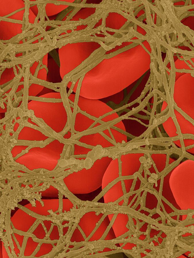Medical Photograph - Blood Clot by Dennis Kunkel Microscopy/science Photo Library Medical Photograph - Blood Clot by Dennis Kunkel Microscopy/science Photo Library