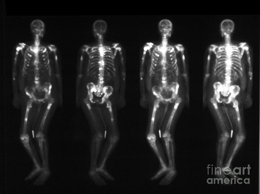 Bone Scan Showing Multiple Metastases #4 Photograph by Scott Camazine