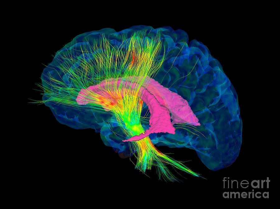 Brain Fibres, Dti Mri Scan Photograph by Sherbrooke Connectivity ...