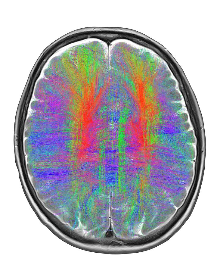 Brain Mri And White Matter Fibres #4 Photograph by Alfred Pasieka/science Photo Library