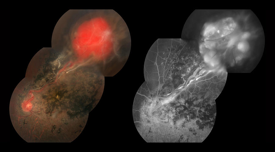 Capillary Hemangioma, Ophthalmic #4 Photograph by Paul Whitten