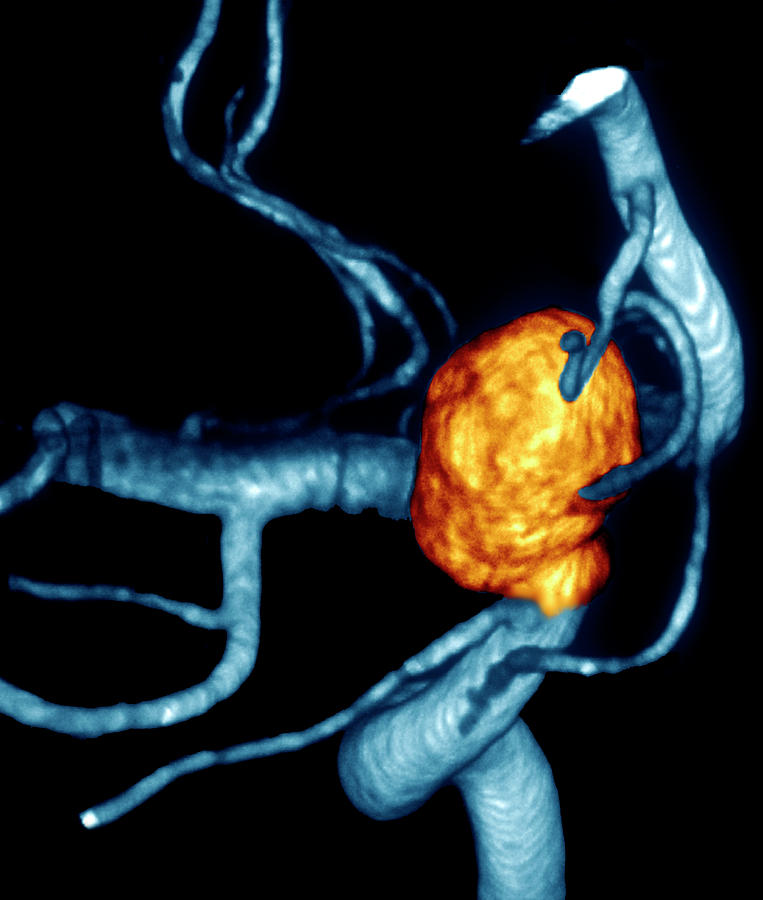 Carotid Aneurysm #4 Photograph by Zephyr/science Photo Library