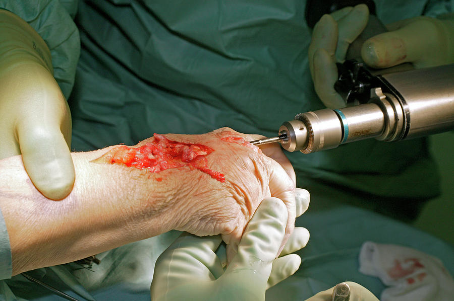carpal tunnel surgery carpal tunnel surgery