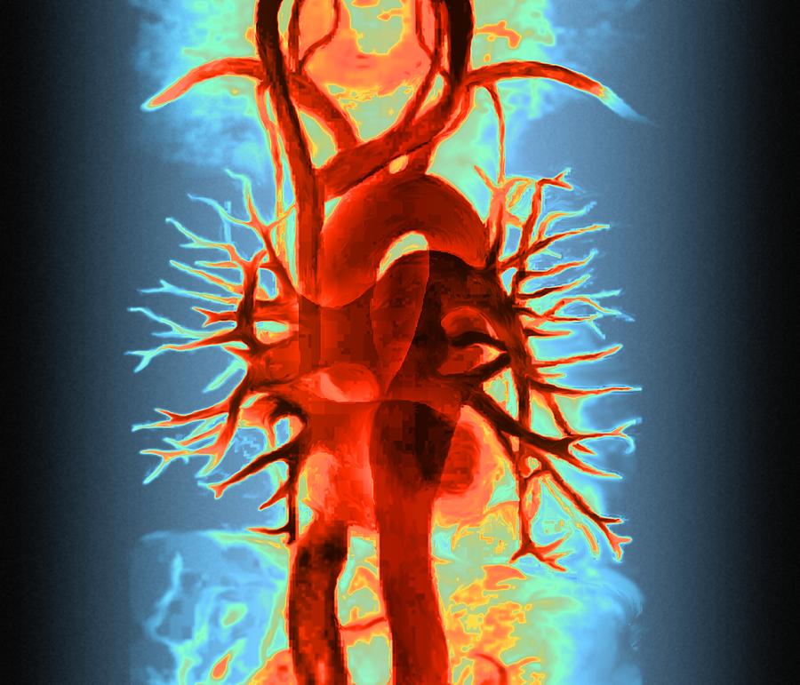 Chest Blood Vessels #4 Photograph by Zephyr/science Photo Library