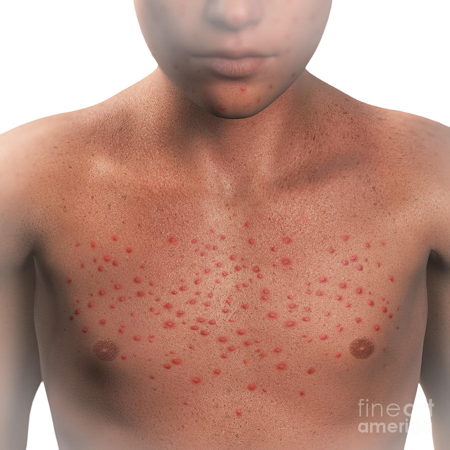 Chickenpox Blisters #4 Photograph by Science Picture Co