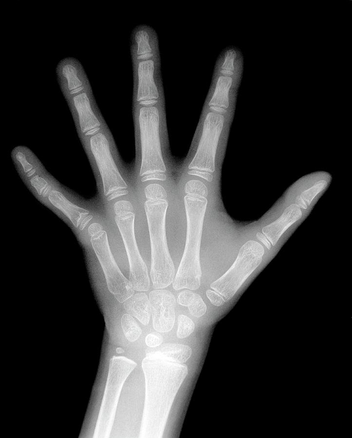 Childs Hand #4 Photograph by Aj Photo/science Photo Library