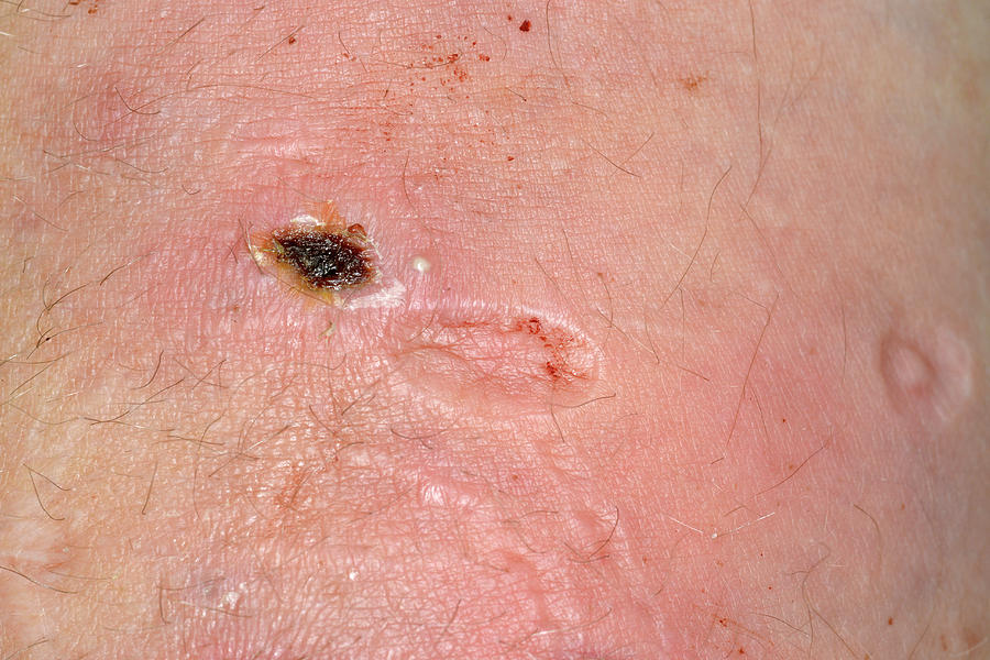 Cigarette Burn Scars In Self-harm Photograph by Dr P. Marazzi/science