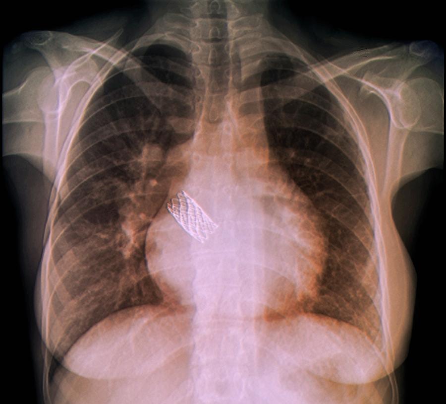 congenital-heart-defects-photograph-by-zephyr-science-photo-library