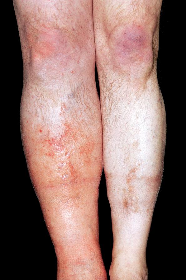 Deep Vein Thrombosis In The Leg Photograph By Dr P Marazziscience Photo Library 9062