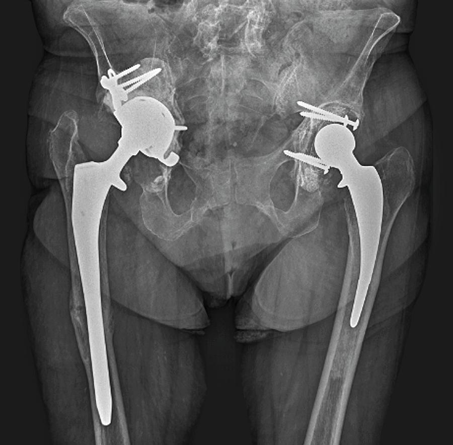 Double Hip Replacement Photograph by Zephyr/science Photo Library