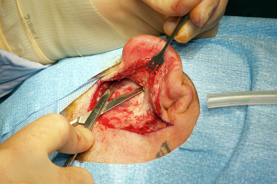 Human Photograph - Ear Surgery by Dr P. Marazzi/science Photo Library Human Photograph - Ear Surgery by Dr P. Marazzi/science Photo Library