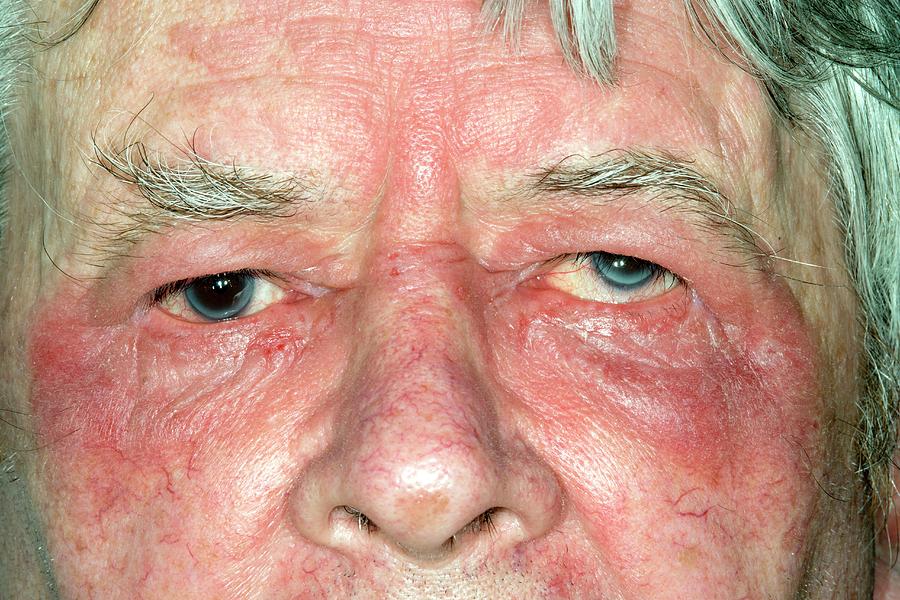 Eczema Around The Eye Photograph By Dr P Marazzi Science Photo Library