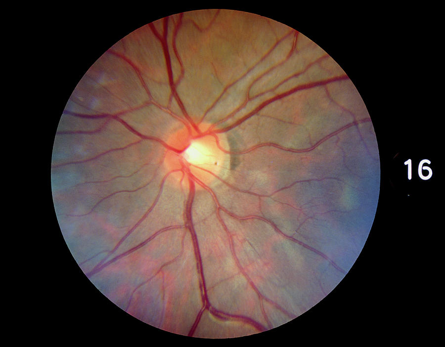 Fundoscopy Photograph - Fundus Camera Image Of A Normal Retina #4 by Rory Mcclenaghan/science Photo Library