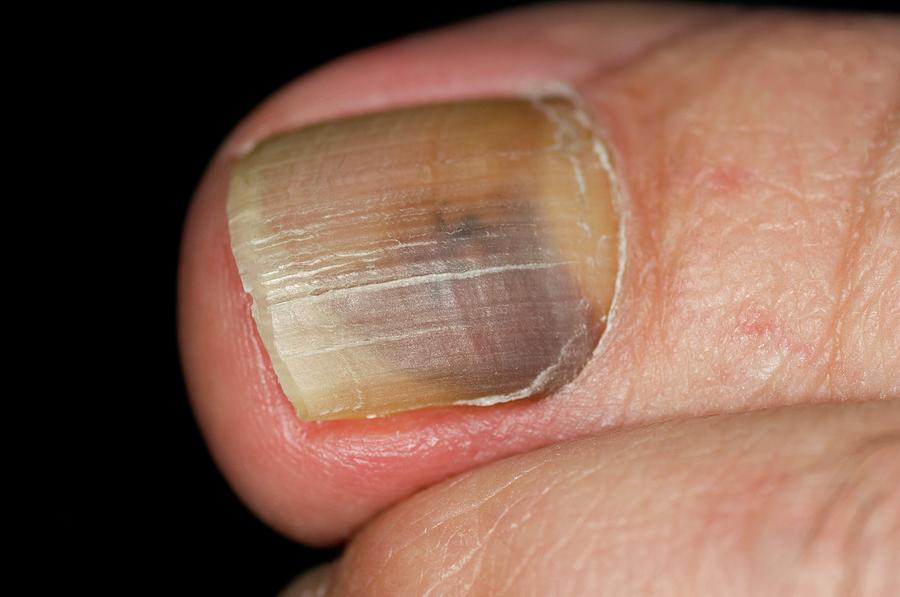 Will A Fungal Toenail Infection Go Away