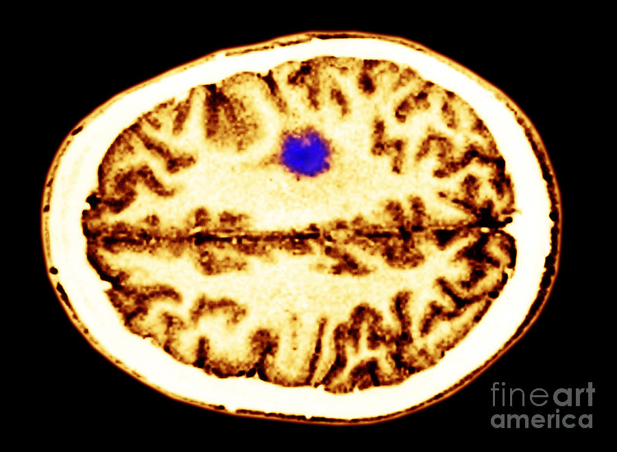 Glioma Brain Tumor #4 Photograph by Scott Camazine