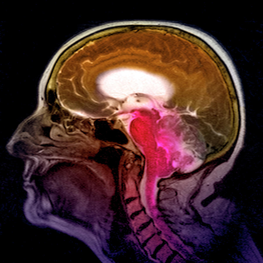 Haemangioblastoma Brain Tumour #4 Photograph by Simon Fraser/science Photo Library