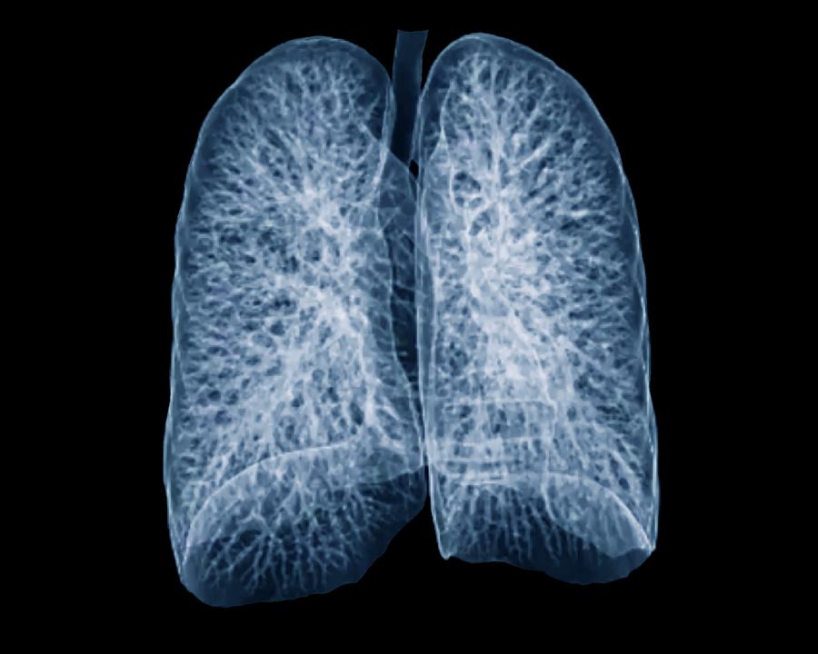 Healthy Lungs Photograph by Zephyr - Pixels