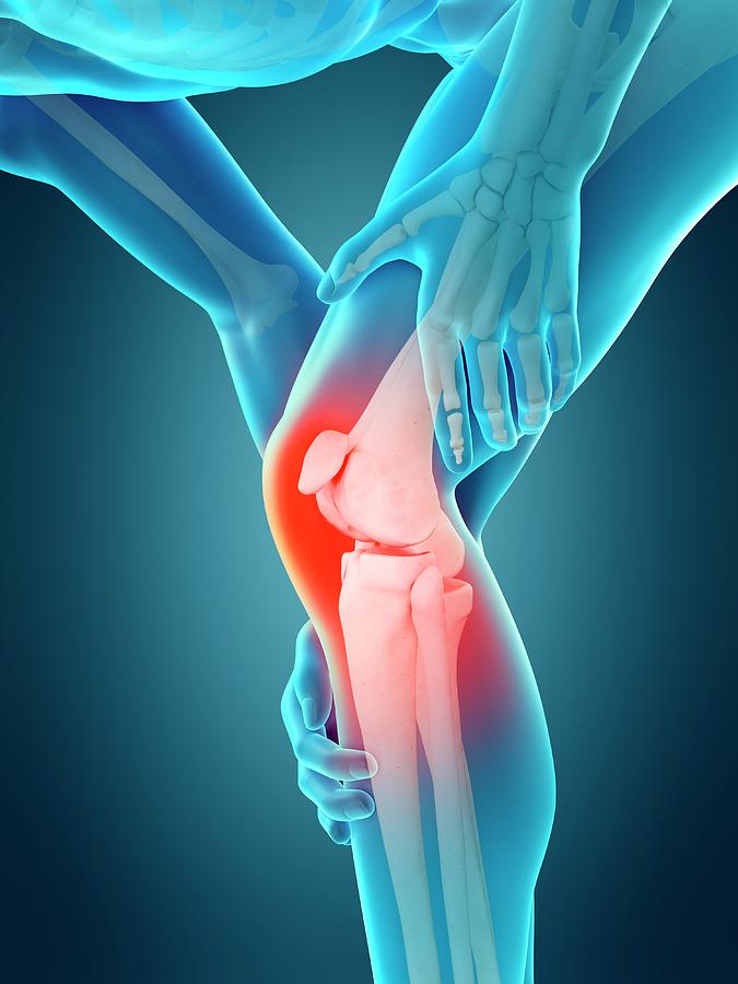 Human Knee Pain Photograph By Sebastian Kaulitzkiscience Photo Library