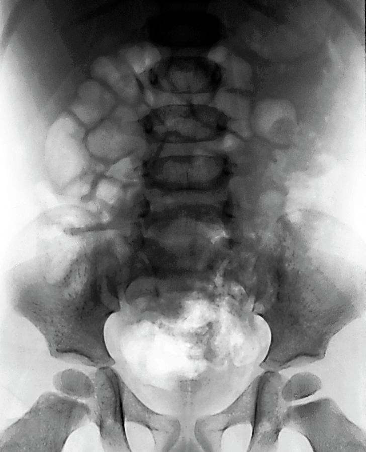 Intussusception Of The Intestines #4 Photograph by Zephyr