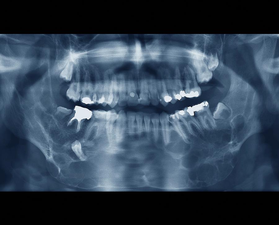 Jaw Cancer (ameloblastoma) #4 Photograph by Zephyr/science Photo Library