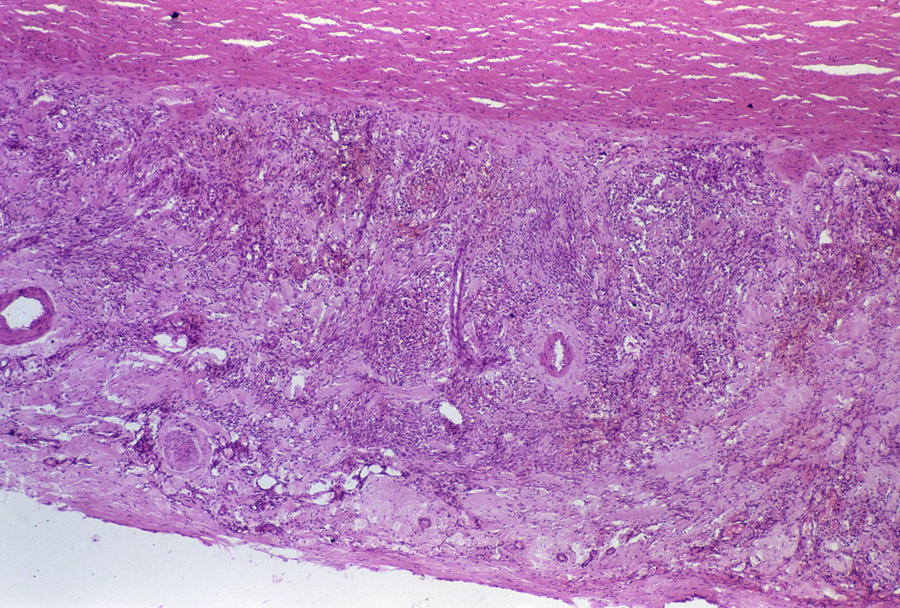 Kaposis Sarcoma Photograph By Dr Ma Ansaryscience Photo Library