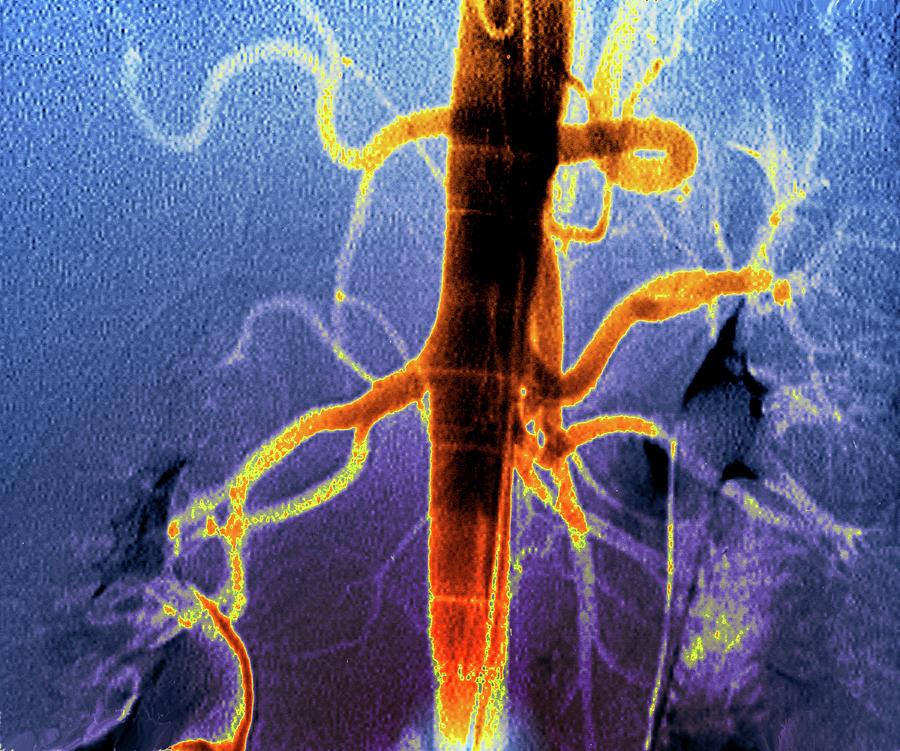 Kidney Blood Vessels Photograph By Zephyrscience Photo Library Fine