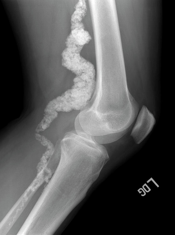 Knee In Acdc #4 Photograph by National Human Genome Institute