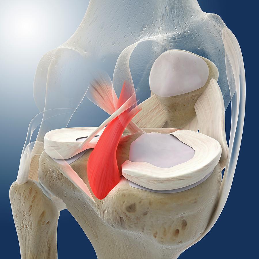 Knee Pain #4 Photograph by Springer Medizin/science Photo Library