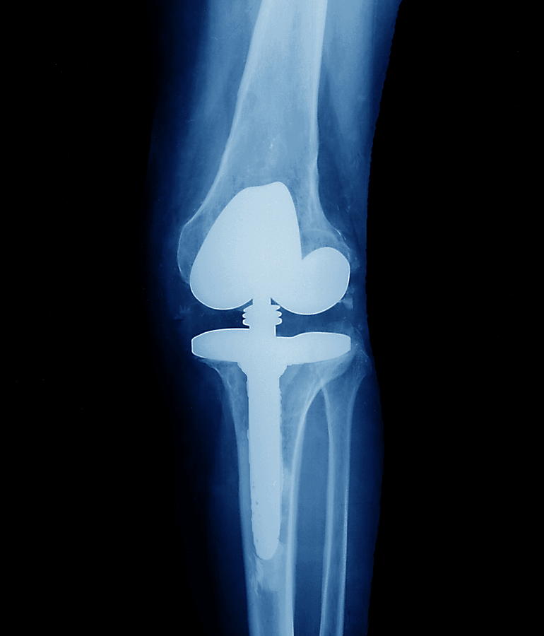 Knee Replacement Photograph By Zephyr Science Photo Library Fine Art America