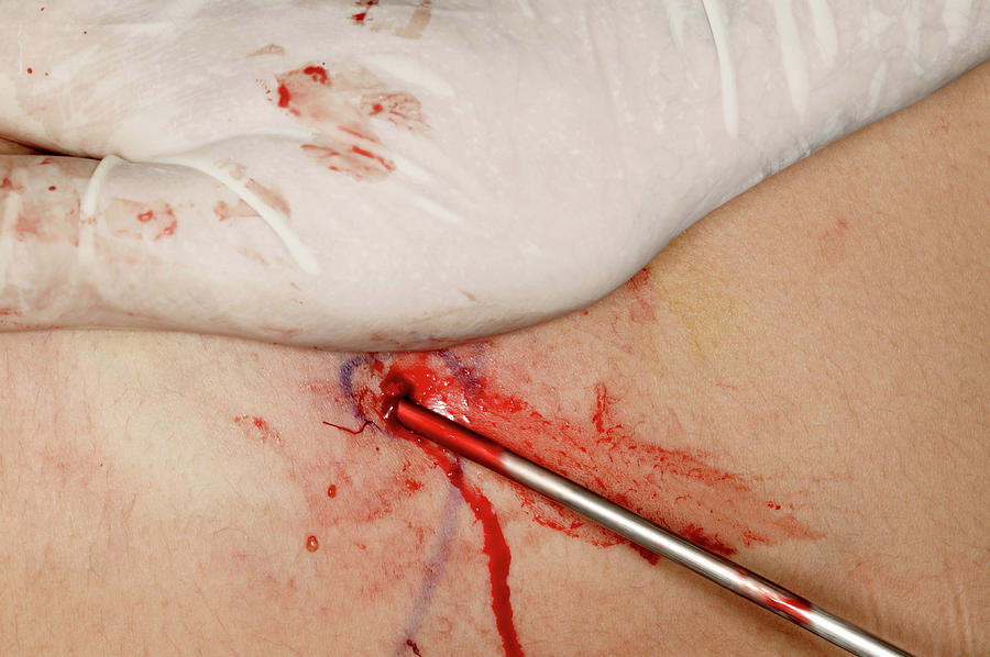 Liposuction Surgery #4 Photograph by Mauro Fermariello/science Photo Library