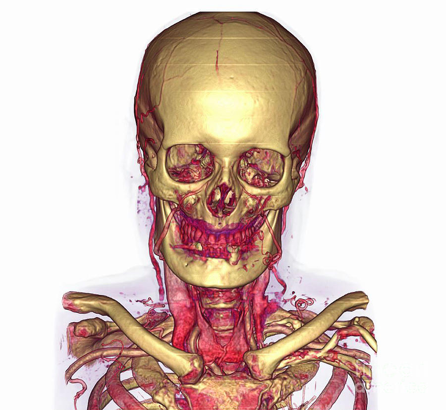 Male Skull & Arterial System Photograph by Scott Camazine