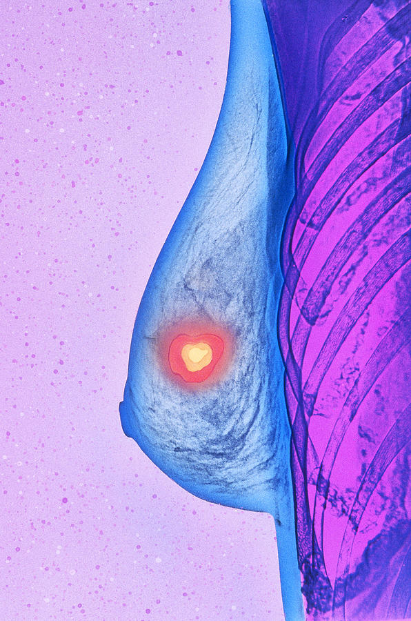 Mammogram #4 Photograph by Chris Bjornberg