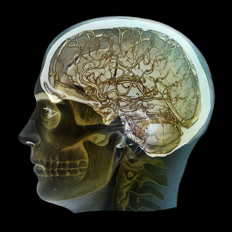 Normal Brain Blood Supply Photograph by Zephyr/science Photo Library ...