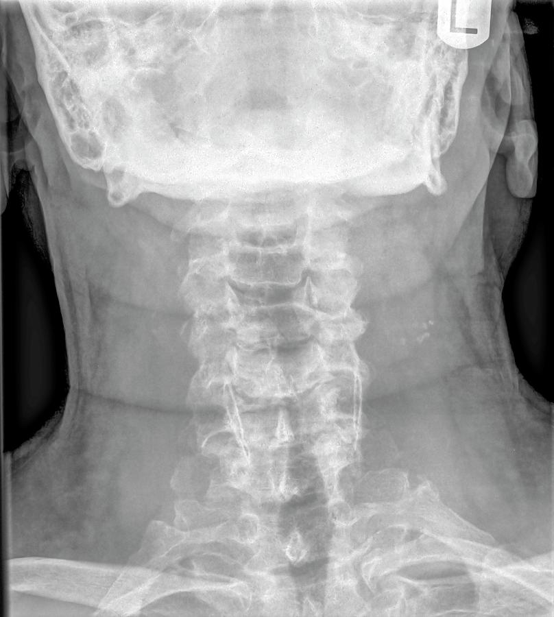 healthy cervical spine x ray
