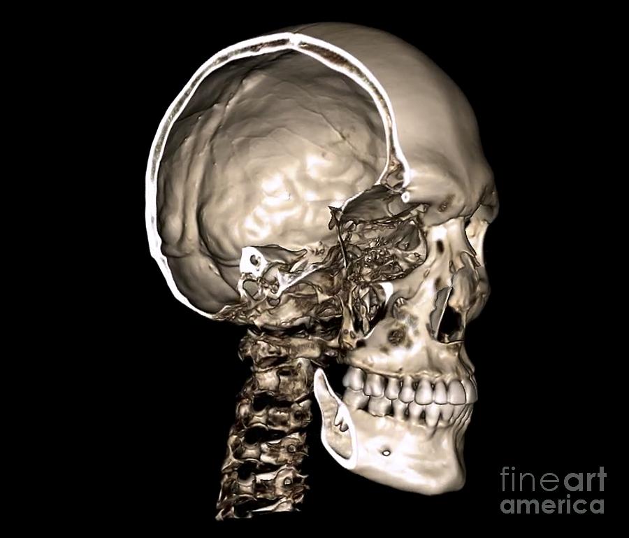 Normal Skull 3d Ct Scan Photograph By Zephyr Pixels