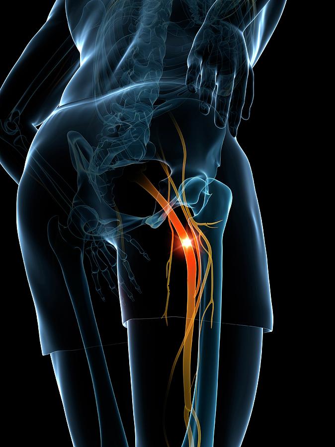 painful-sciatic-nerve-photograph-by-sciepro-science-photo-library-pixels