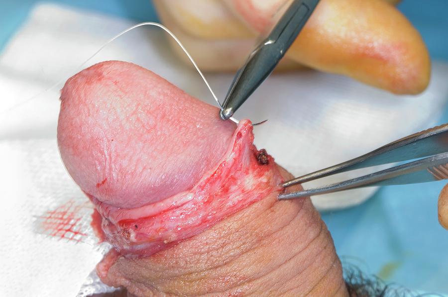 doctors photographing penis Doctors photographing penis