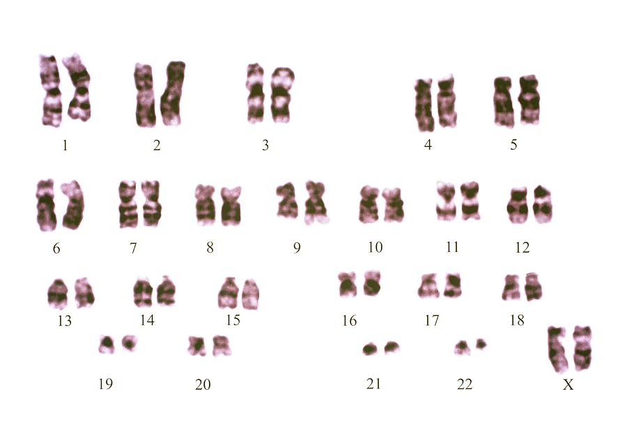 Philadelphia Chromosome #4 Photograph by Dept. Of Clinical Cytogenetics, Addenbrookes Hospital/science Photo Library