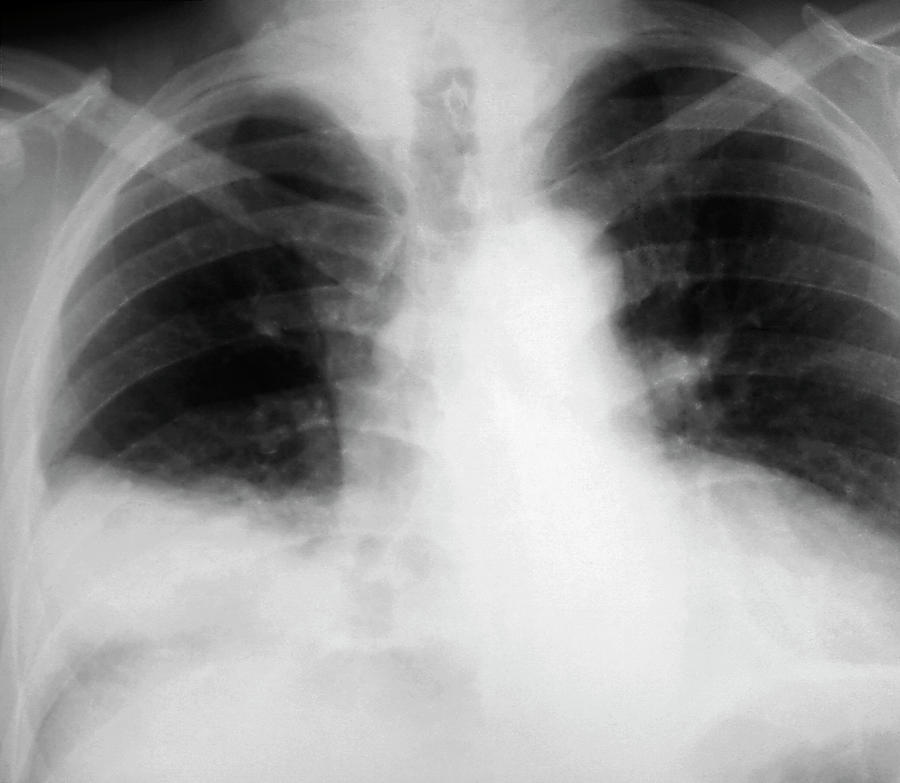 Pneumonia Photograph by Zephyr/science Photo Library - Fine Art America