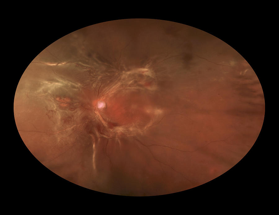 Proliferative Diabetic Retinopathy Photograph By Paul Whitten Pixels