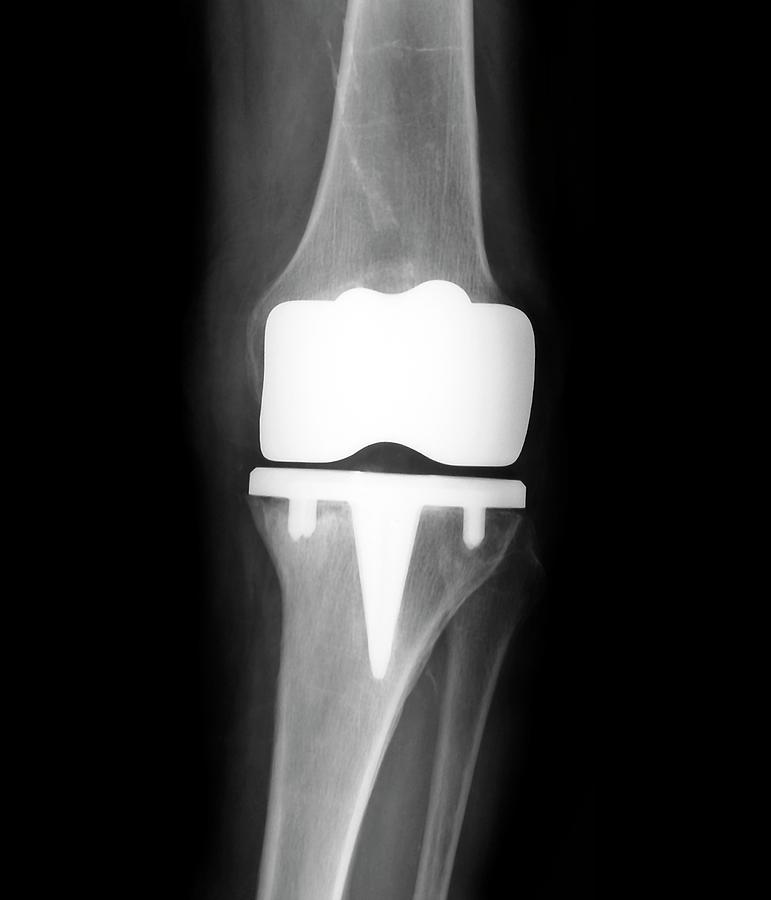 Prosthetic Knee Joint Photograph By Zephyr/science Photo Library | Fine ...