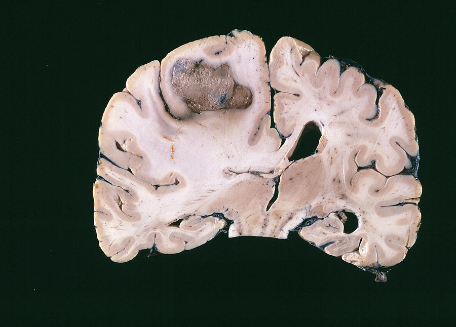 Secondary Brain Cancer Photograph by Cnri/science Photo Library - Fine ...