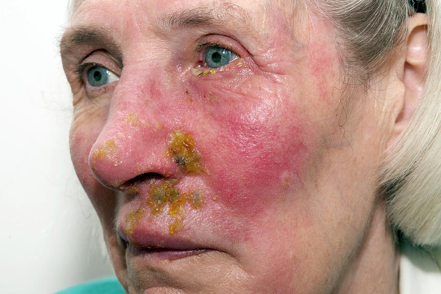 Shingles Rash On The Face Photograph by Dr P. Marazzi/science Photo Library