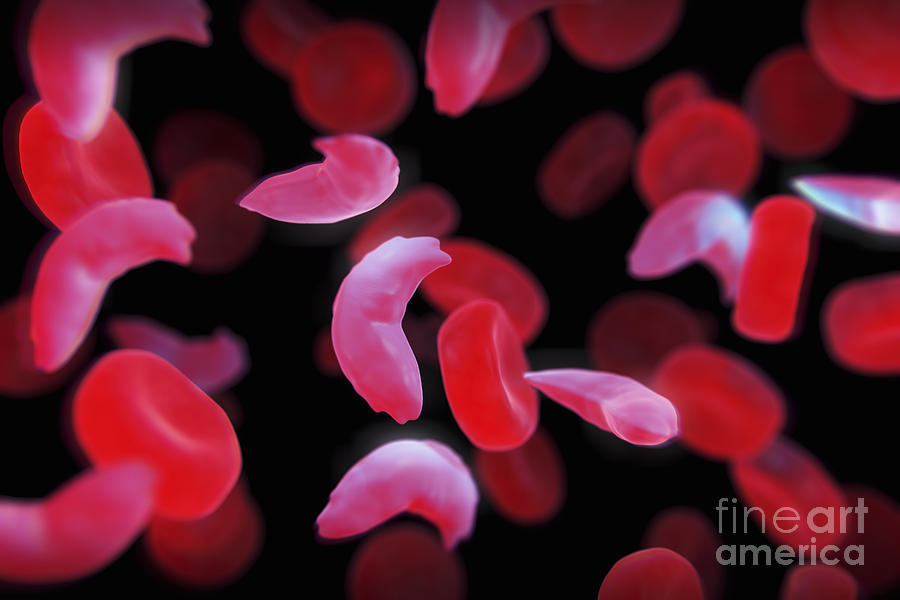Sickle-cell Disease #4 Photograph by Science Picture Co