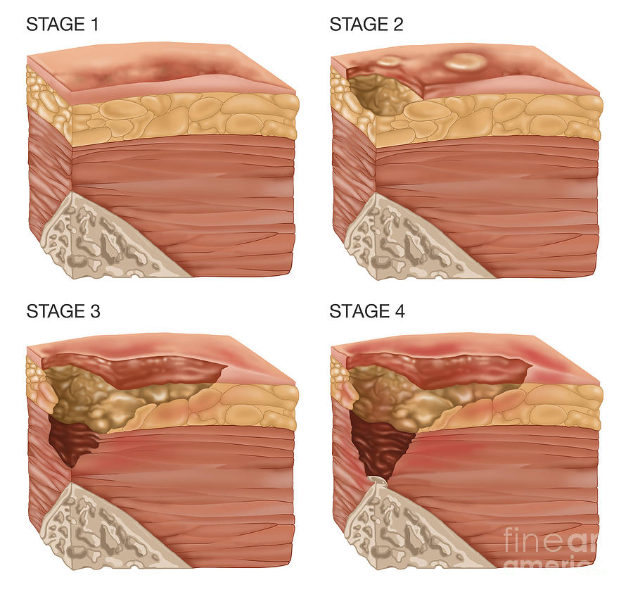 4 Stages Of A Bedsore, Illustration Photograph by Gwen Shockey