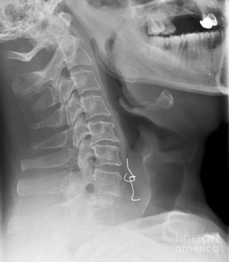 Swallowed Denture, Xray Photograph by Du Cane Medical Imaging Ltd.