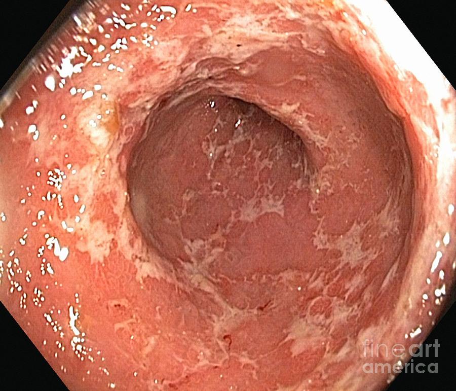 Digestive System Photograph - Ulcerative Colitis, Endoscopic View #4 by Gastrolab