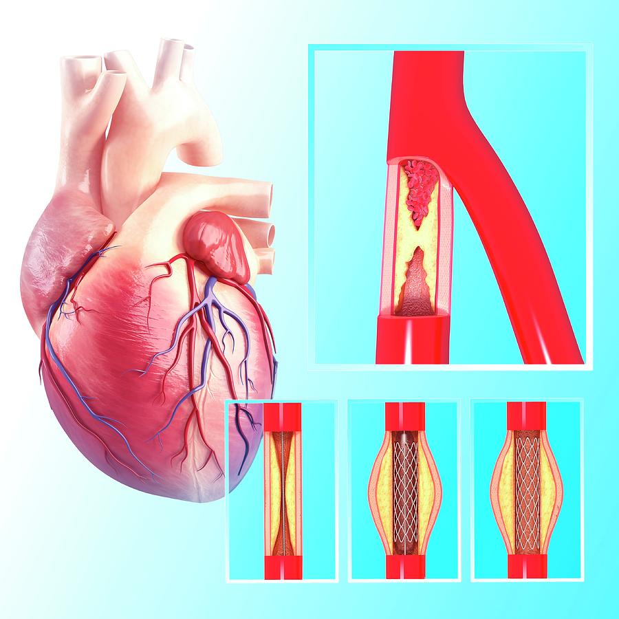 Angioplasty 40 By Science Photo Library 6592