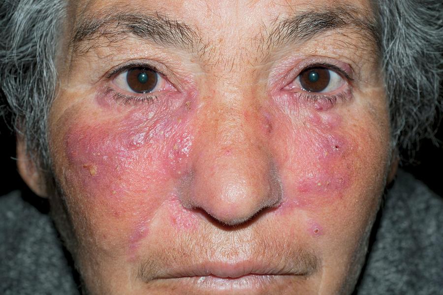 Acne Rosacea On The Face Photograph By Dr Harout Tanielianscience